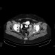 Tumorous stenosis of sigmoid colon: CT - Computed tomography